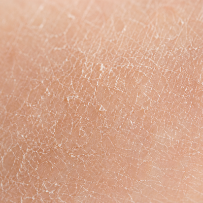 Dryness/Hydration