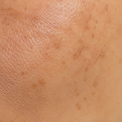 Pigmentation/Brightening