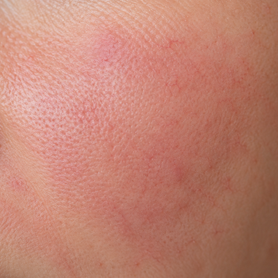 Redness/Sensitive