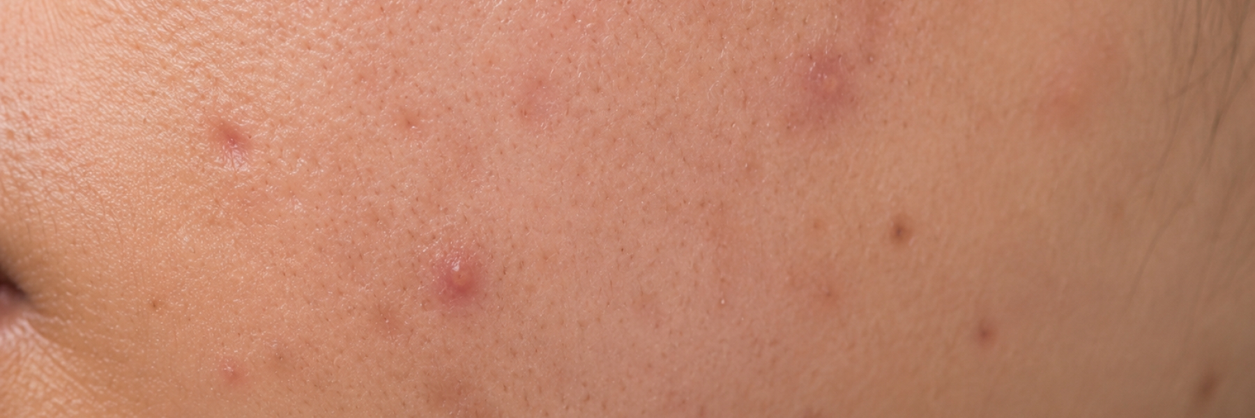 Acne/Pimples