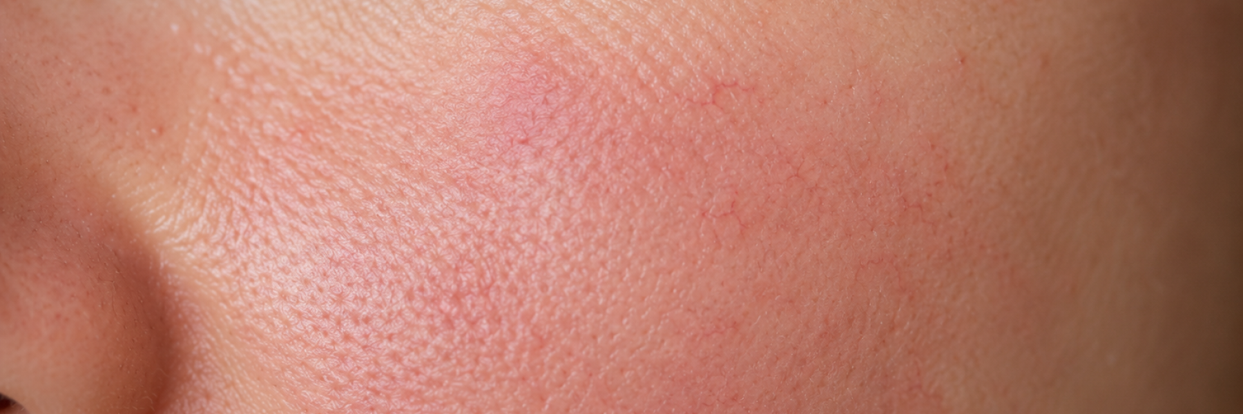 Redness/Sensitive