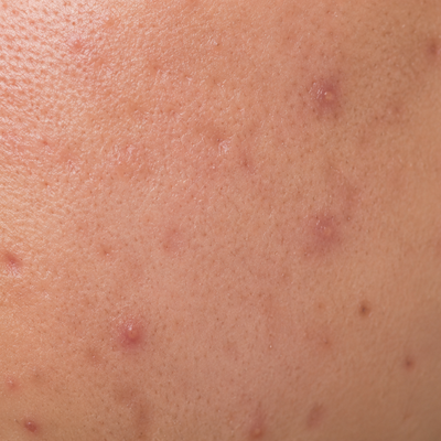 Acne/pimples