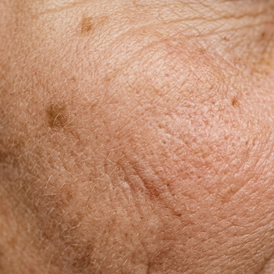 Anti-Aging